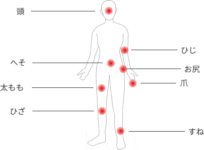 乾癬の皮膚症状が出やすい場所：頭、ひじ、へそ、お尻、爪、太もも、ひざ、すね